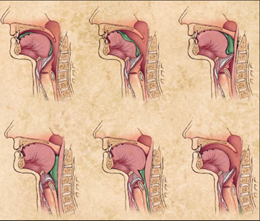 ALS-Awareness-Month-Swallowing How an NYGH Research Chair is making a difference in ALS-connected Disorder